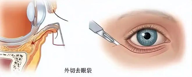 的技术？拉皮手术面部提升无锡苏州杭州米乐m6登录入口去除眼袋有什么比较好
